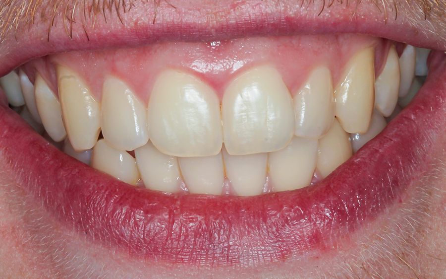 teeth whitening - case 3 - 3Dental